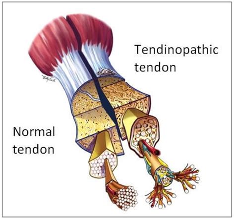 Tendinopathy/Tendinitis: Causes, Symptoms, Treatment and Exercises | Rebalance Sports Medicine