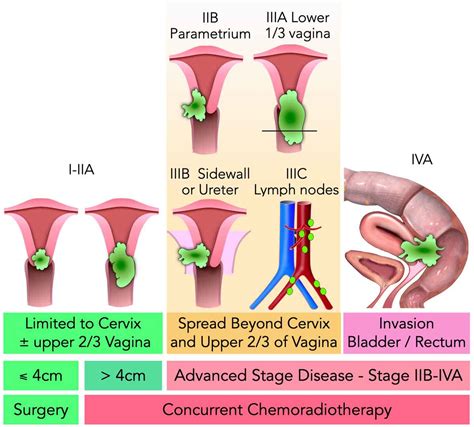 Cervix Cancer Staging