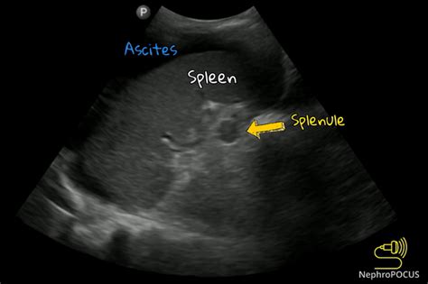 Accessory Spleen – NephroPOCUS