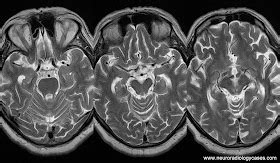 Dr Balaji Anvekar FRCR: Progressive Supranuclear Palsy MRI