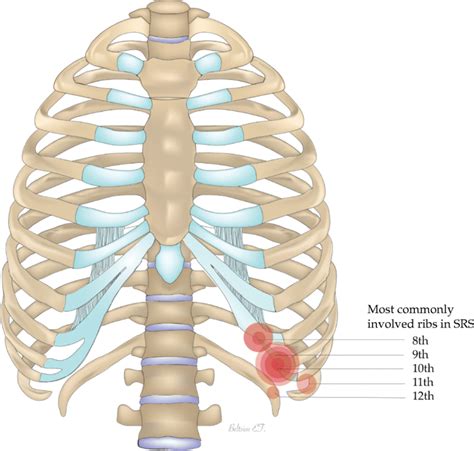 The most commonly involved ribs in slipping rib syndrome. Image ...