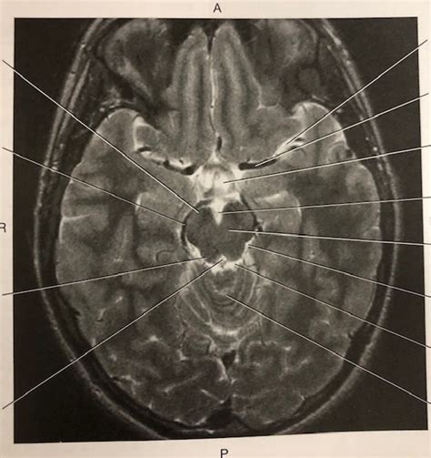 Axial T2 MRI Cisterns Diagram | Quizlet