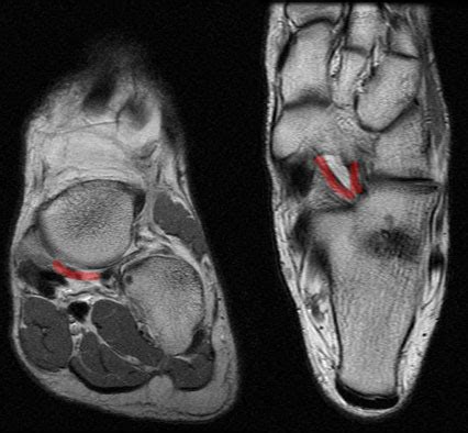 Radiology Anatomy Images : Spring Ligament in Ankle MRI Anatomy