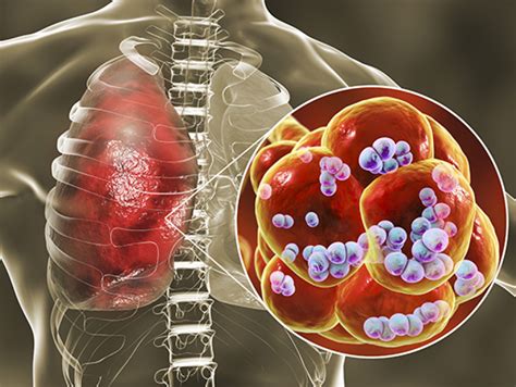 Metastatic Lung's Cancer : An overview