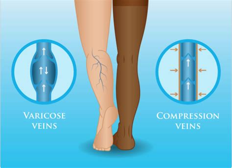 Why You Should Use Compression Socks for Varicose Veins