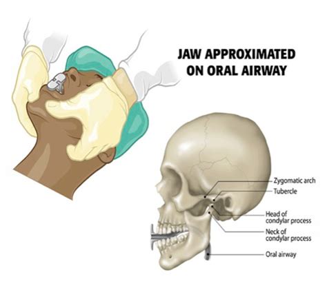 Advancing Airway Management: Opening and Maintaining the Airway