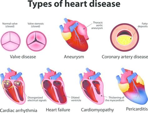 Heart Disease: Symptoms, Causes, Treatment, and Diagnosis | FindATopDoc