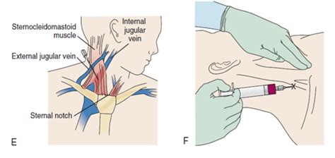 The Blind IJ Central Catheter — EM Curious