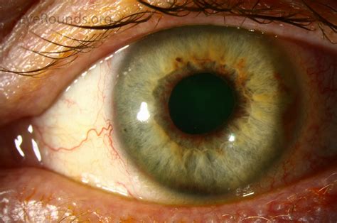 Atlas Entry - Rubeosis iridis or neovascularization of the iris in diabetes