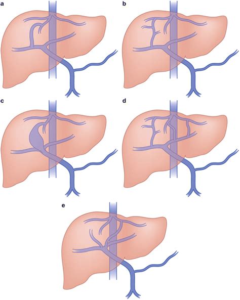 Congenital Portosystemic Shunts: Diagnosis and Percutaneous Management ...