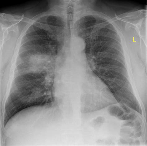 Lobar pneumonia (also known as a non-segmental pneumonia or focal non ...