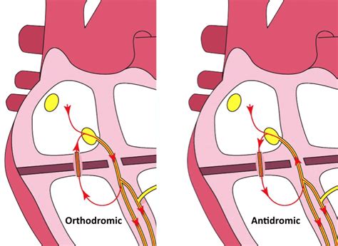 Wolff-Parkinson-White (WPW) syndrome | SCVMC IM Chief Resident Blog