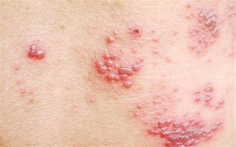 What Are Shingles? A Closer Look at the Reality of Shingles | Reader's Digest