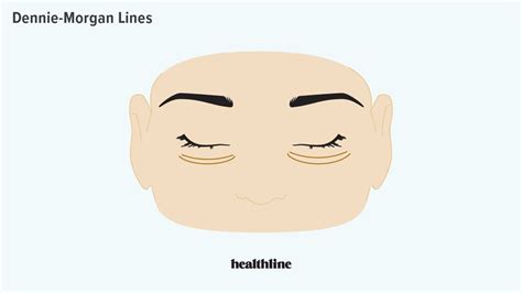 Dennie-Morgan Lines Causes and Proven Treatments for the Eye Wrinkles