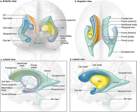 Ventricular and Periventricular Arteriovenous Malformations | Neupsy Key