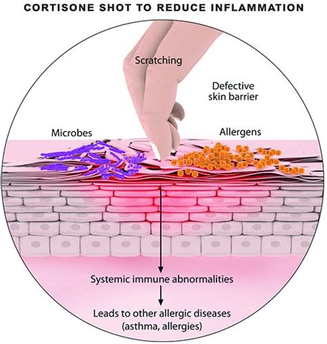 Cortisone Shots · Pain Specialist · 2021 Top Laser Dermatologist NYC