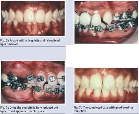 Overbite reduction - Orthodontic Treatment - RR School Of Nursing