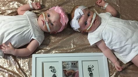 Formerly conjoined twins recovering after 'terrifying' separation - Good Morning America