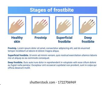 Avoiding Frostbite Banner Visual Symptoms Hands Stock Vector (Royalty Free) 1722706969 ...