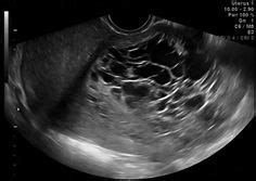 WK 3 L 2 Nabothian cyst longitudinalNabothian cyst with a cystic structure in the cervix in a ...