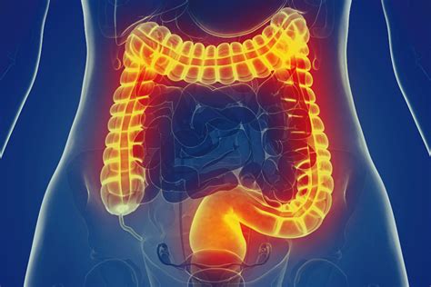 What is the Best Treatment for Irritable Bowel Syndrome