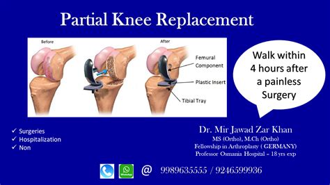 Best Orthopedic Doctor in Hyderabad | Partial knee replacement, Knee replacement, Rheumatoid ...