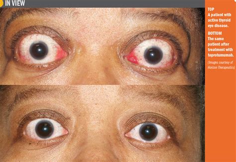 Study: Therapy reduces proptosis, diplopia in TED | Ophthalmology Times