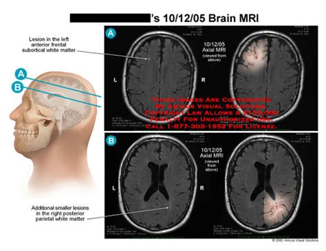 Brain MRI