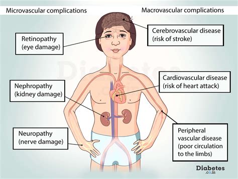 What are the Long term Complications of Diabetes?