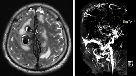 Superior sagittal sinus thrombosis with intraparenchymal haemorrhages – Radiology Cases