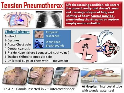 #Tension #Pneumothorax Nursing Mnemonics, Icu Nursing, Nursing Study, Nursing Notes, Nursing ...