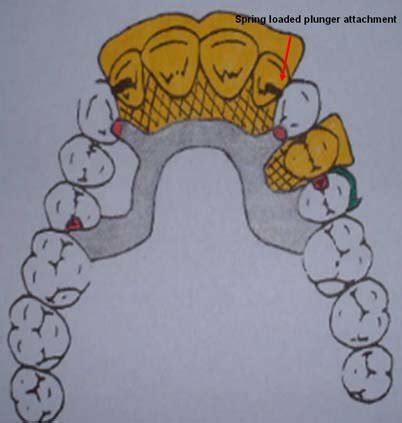 The design of cobalt-chromium denture. | Download Scientific Diagram