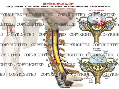 C5-6 left posterolateral, paracentral disc protrusion- male — Medical ...