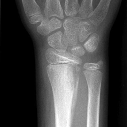 Osteomyelitis | Radiology Reference Article | Radiopaedia.org