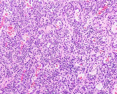 Oral Pyogenic Granuloma Histology