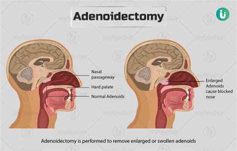 Adenoidectomy: Procedure, Purpose, Results, Cost, Price