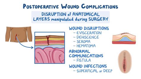 Approach to postoperative wound complications: Clinical sciences - Osmosis Video Library