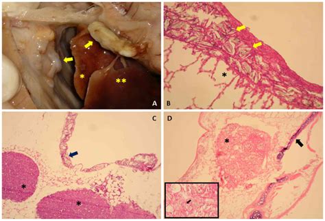 Observational analysis on inflammatory reaction to talc pleurodesis ...