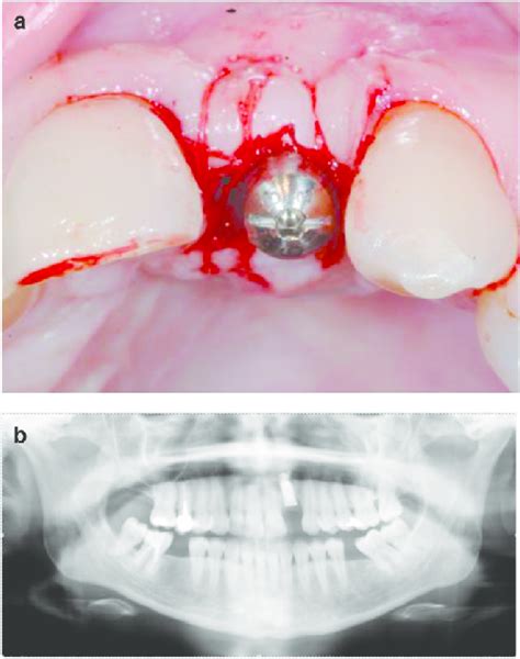 Abutment placement 3 months after implant placement. 11a Coronal... | Download Scientific Diagram