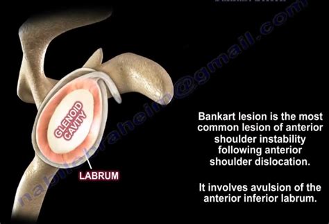 Bankart lesion — OrthopaedicPrinciples.com