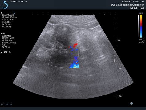 VIETNAMESE MEDIC ULTRASOUND: CASE 457: AML KIDNEY TUMOR, Dr PHAN THANH HẢI, Dr NGUYỄN HOÀNG ĐỨC ...