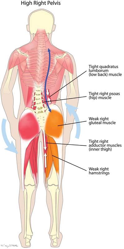 Understanding Low Back Pain Chart Poster Laminated ...