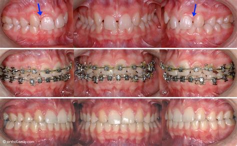 Treatment Options for Congenitally Missing Lateral Incisors | Download ...