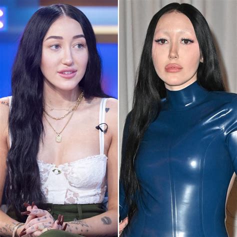 Did Noah Cyrus Ever Have Plastic Surgery? See the Singer’s Transformation Over the Years