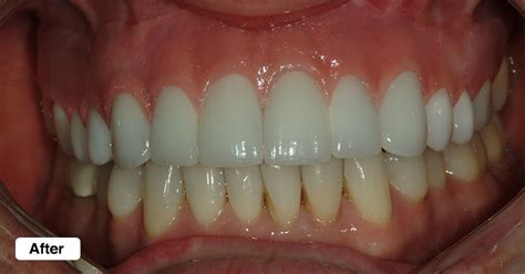 DOs and DONTs in DENTISTRY: Gingival Mask for gingival recession patients