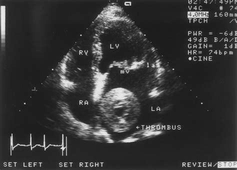 Mobile Left Atrial Thrombus Associated With Mitral Stenosis | Circulation