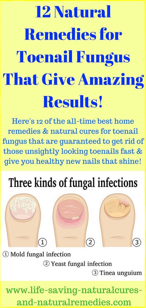 Best Natural Remedies & Home Treatments for Toenail Fungus Removal ...