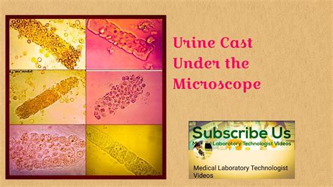 Urine Cast(Types and Causes), urinanalysis - YouTube