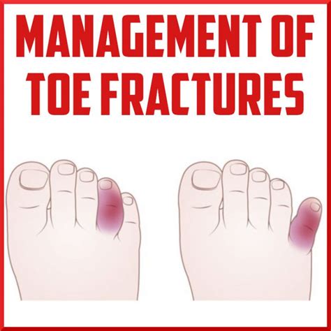 Management of Toe Fractures - Sports Medicine Review