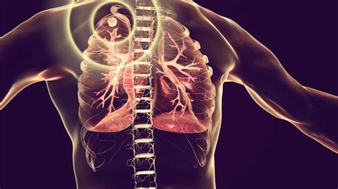 Researchers use AI to improve tuberculosis treatment - TMR Blog